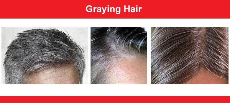 Hair greying (Premature greying)