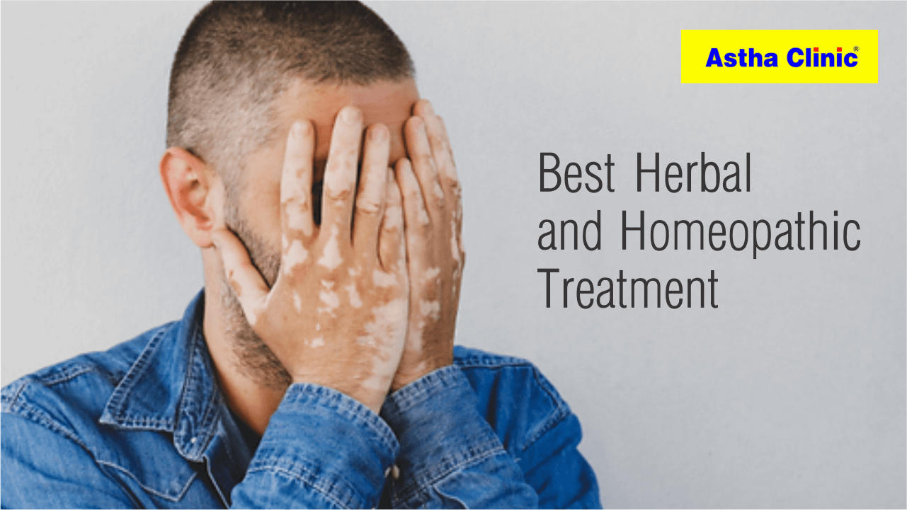 Best Vitiligo Treatment