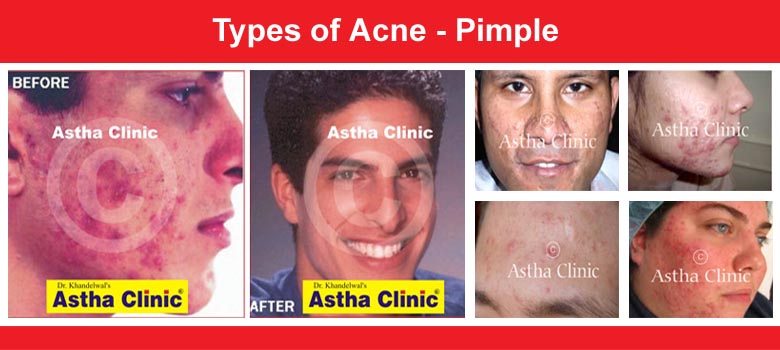 Acne (Pimples)