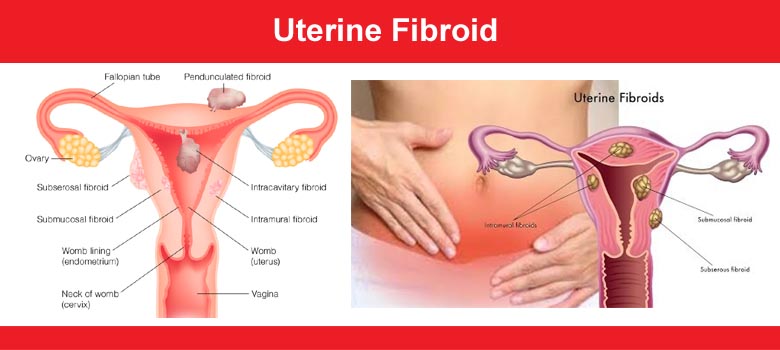 Uterine Fibroid