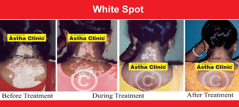 Vitiligo (White Spot)